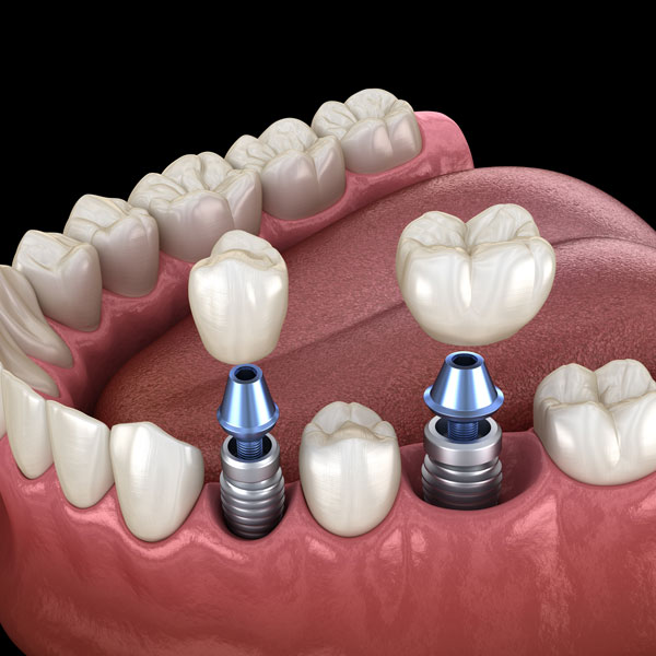 dental implants 3D rendering