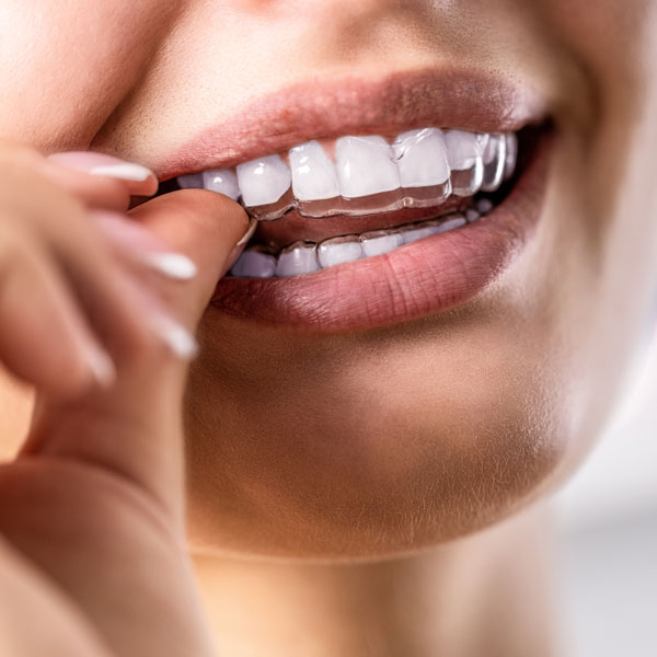 woman putting in invisalign