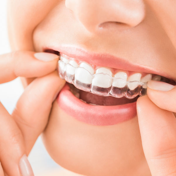 woman placing invisalign on teeth