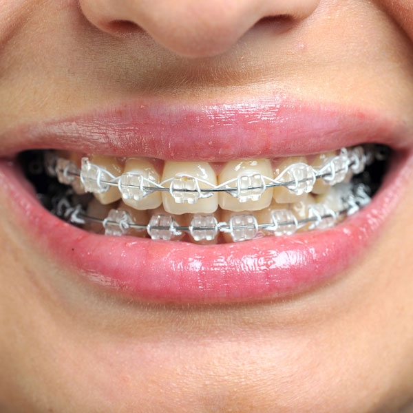 girl with braces smiling